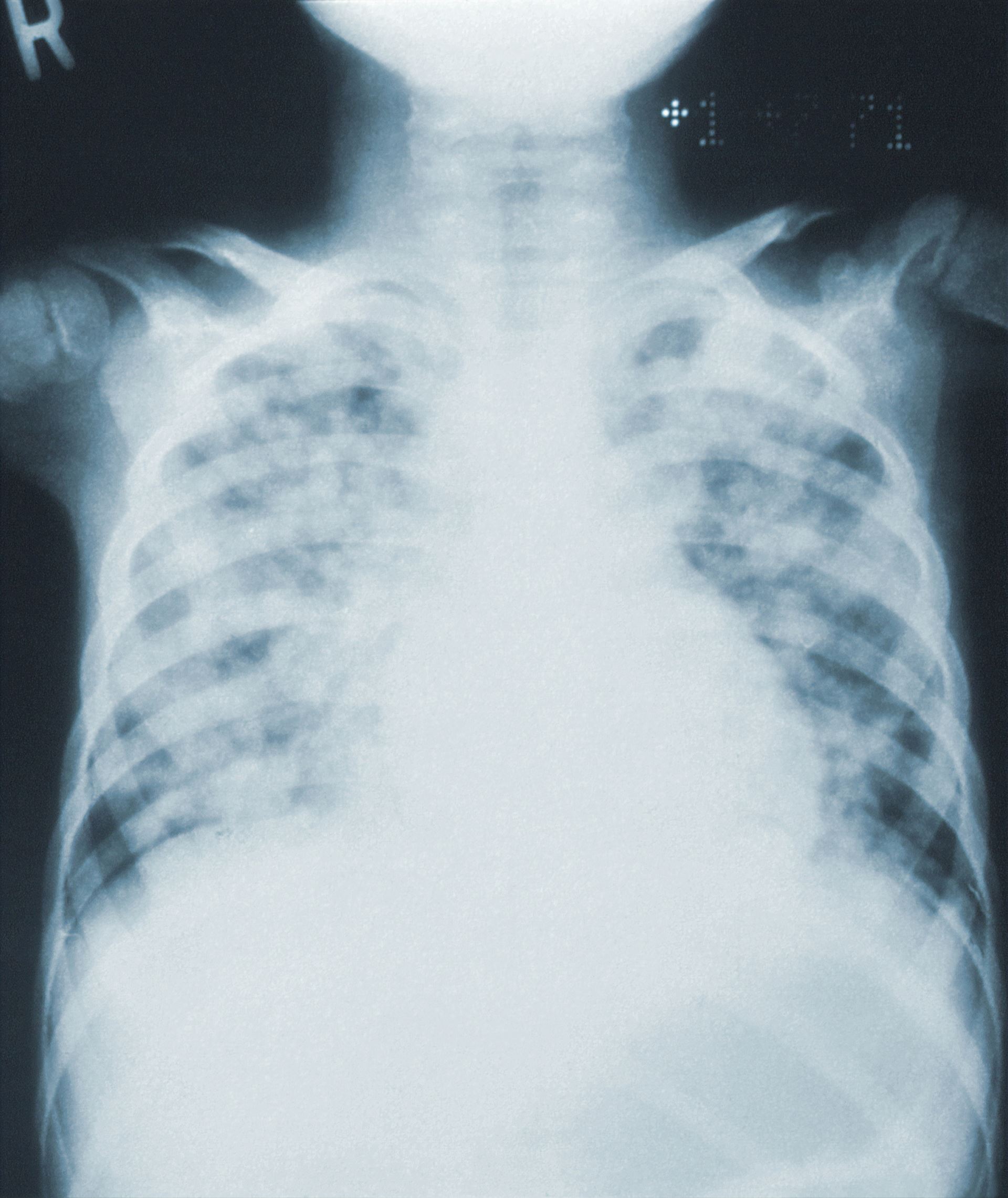 Lung health check